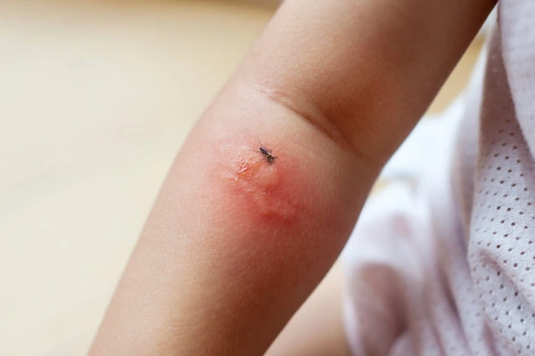 Infected Insect Bites Infected Insect Bites