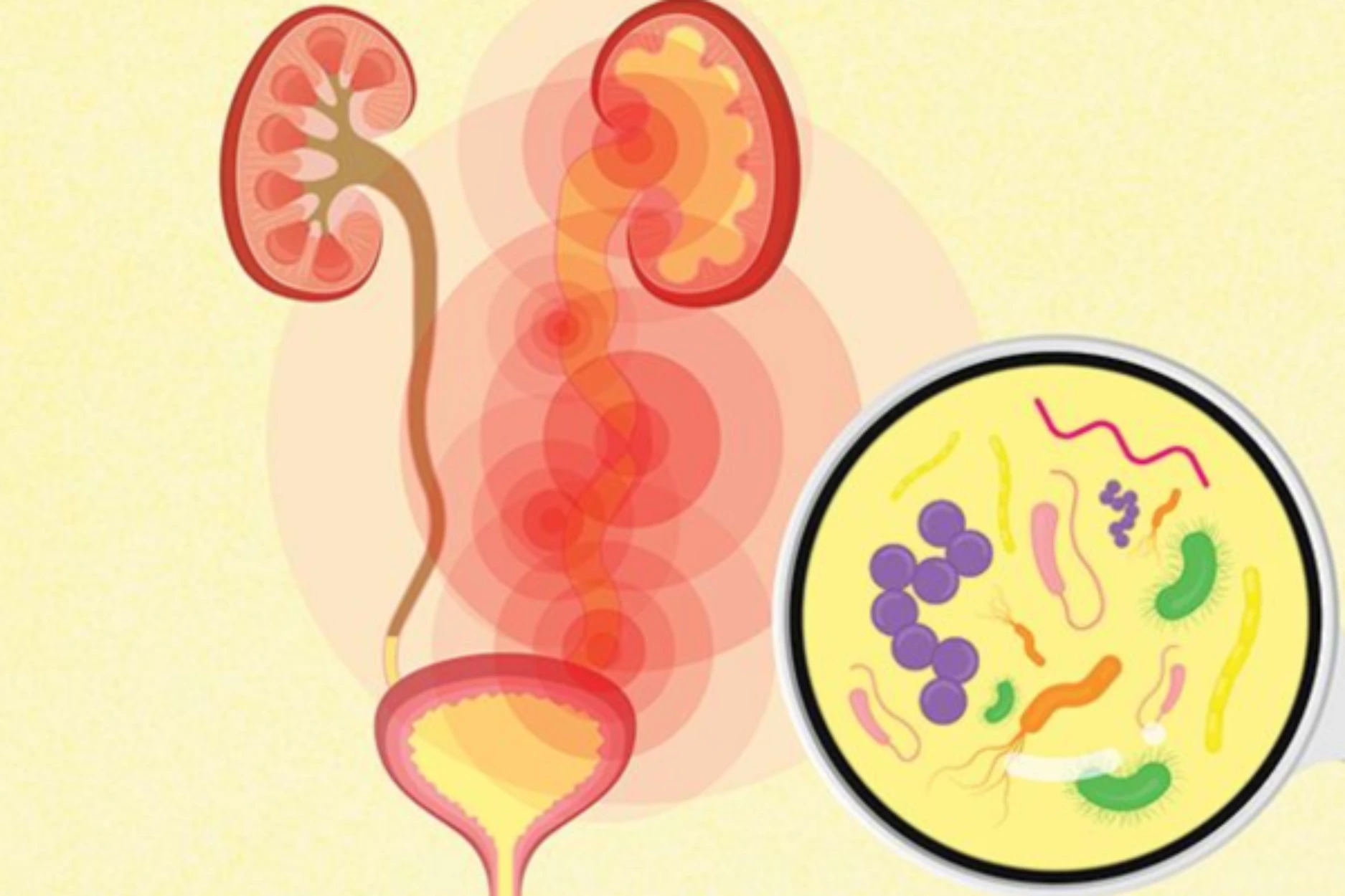 Uncomplicated Urinary Tract Infection (UTIs) Uncomplicated Urinary Tract Infection (UTIs)