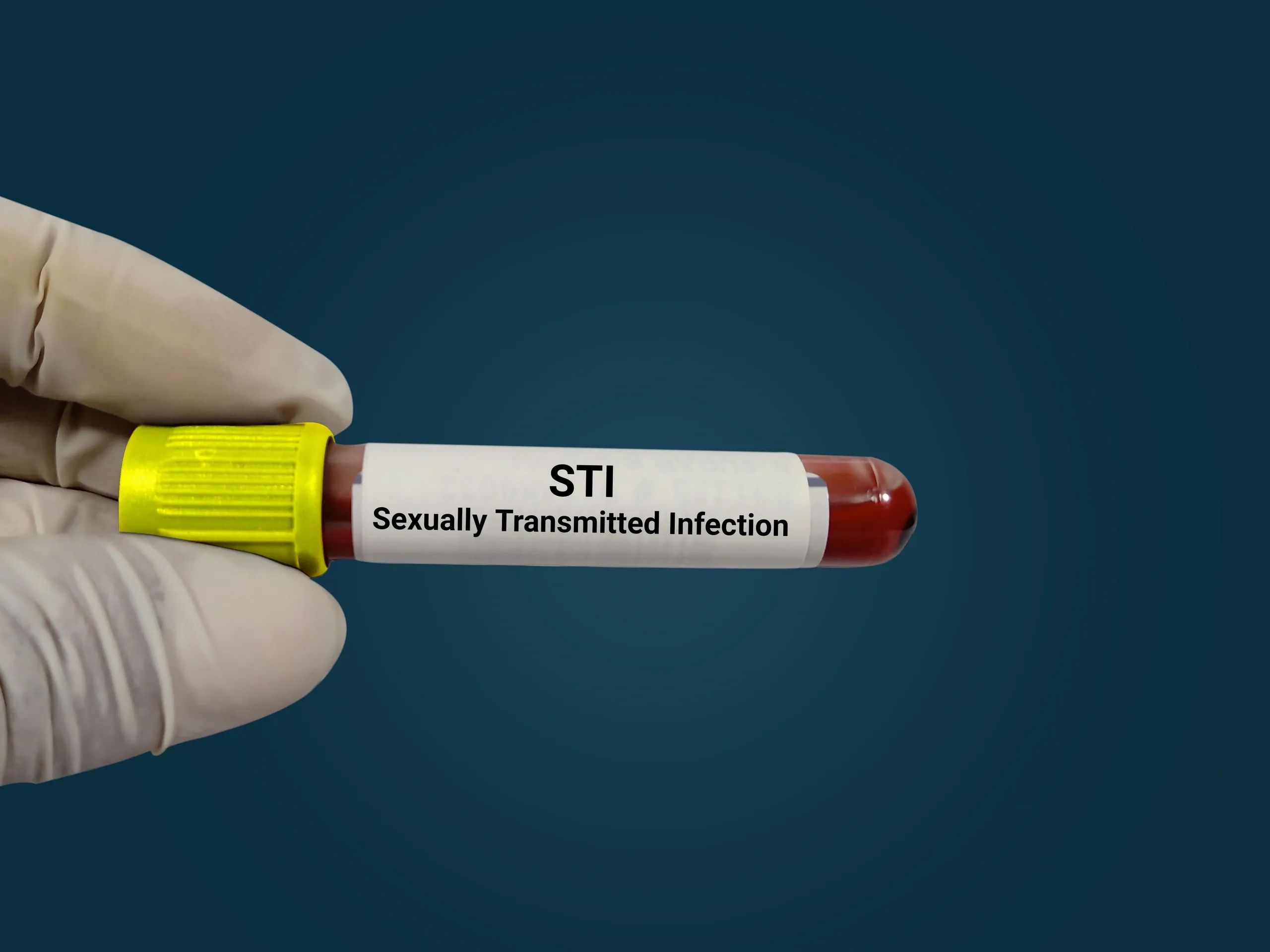STI Self Test kit  (Sexually Transmitted Infection)