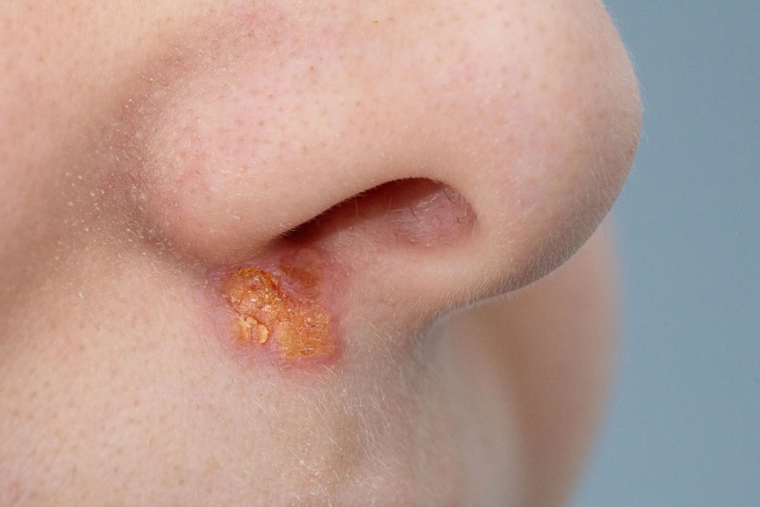 Impetigo Impetigo